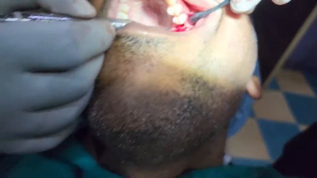 Dental implant Placement смотреть онлайн