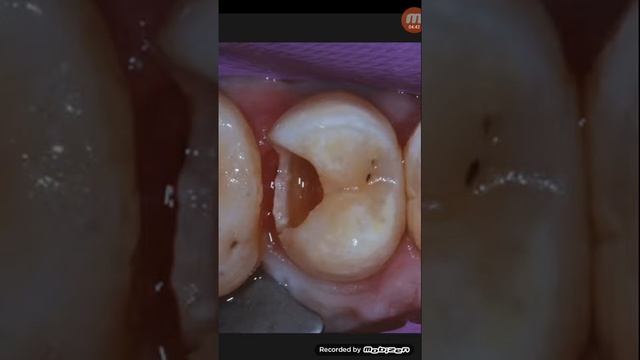 দাঁতের ফিলিং/পুটিং বেশি দিন দীর্ঘস্থায়ী না হওয়ার কারন... смотреть онлайн