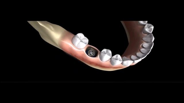 Аппарат для измерения стабильности имплантат MEGA ISQ