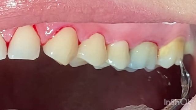 Tartar / Giant Tartar / Dental Scaling / Dentist / Dr Sara The Dentist / Teeth