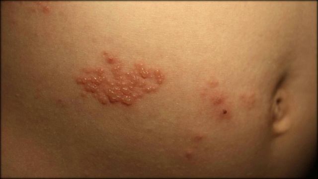 Wann Krankenkassen Ihre Gürtelrosen-Impfung bezahlen смотреть онлайн