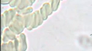 Кровь под микроскопом, Гемосканирование. До лечения.