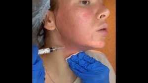 Биоревитализация в домашних условиях