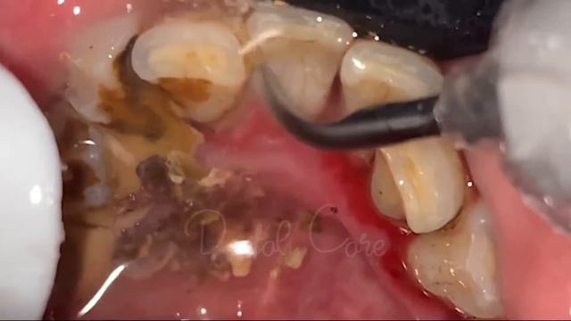 Gingival Inflammation Caused By Bacterial Plaque From Massive Tartar - Remove Tartar