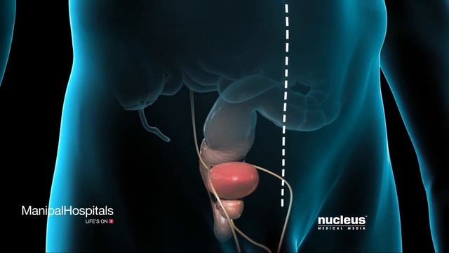 Radical Prostatectomy смотреть онлайн