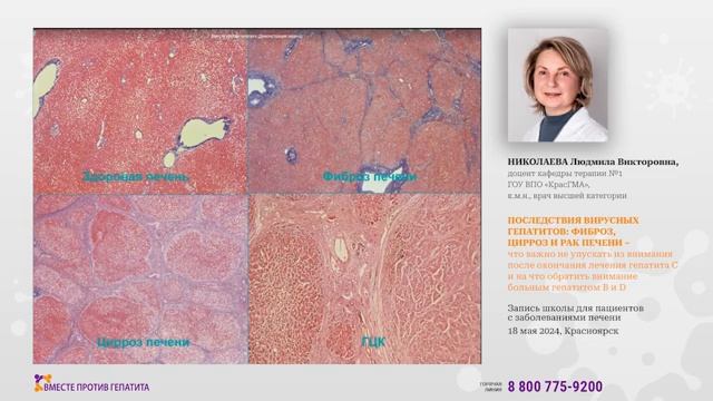 НИКОЛАЕВА ЛВ-Последствия вирусных гепатитов фиброз цирроз и рак печени