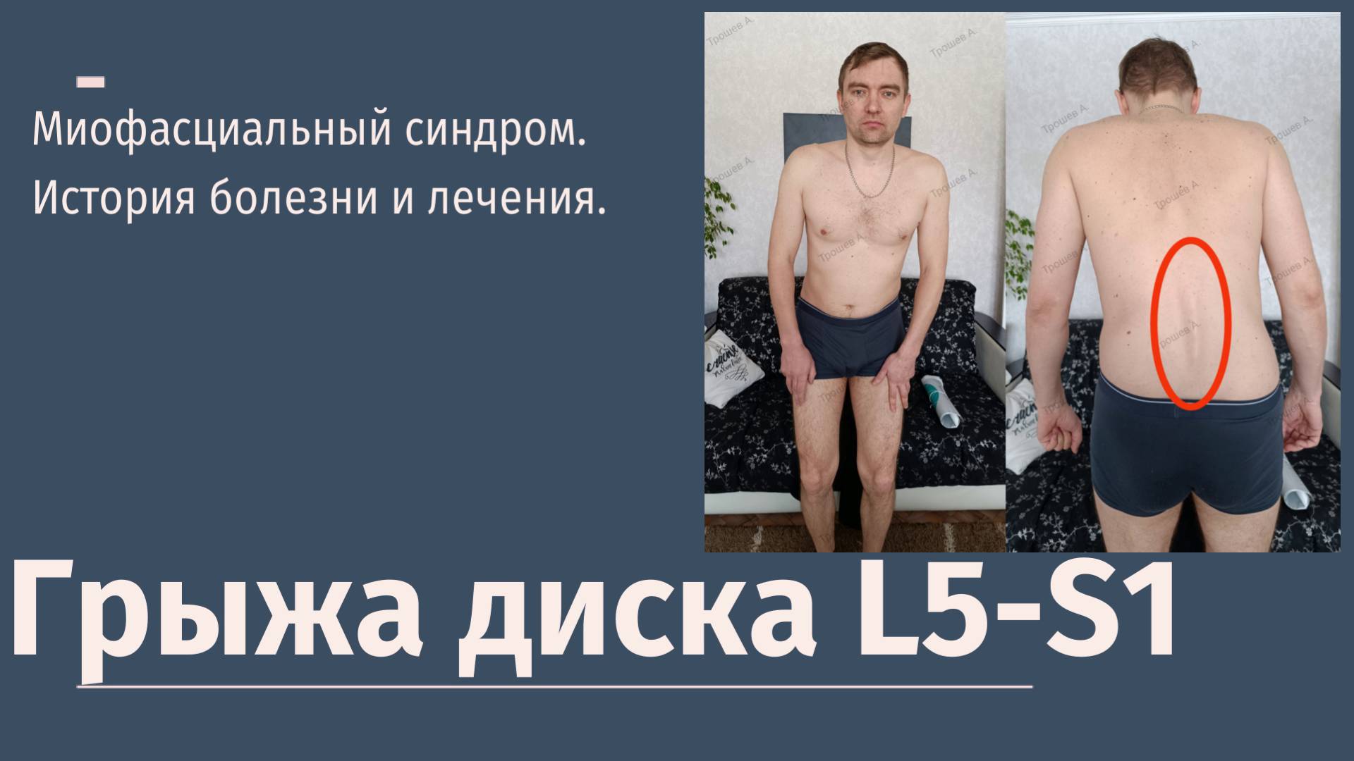 Грыжа диска L5-S1. Миофасциальный синдром, триггерные точки. История болезни и лечения.