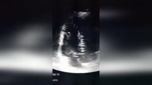 9. Аневризма коронарного синуса с прорывом