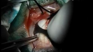 Окончатая склеропластика аллогенным биоматериалом серии Аллоплант