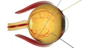 Отслойка сетчатки, симптомы, лечение. Лазерная коагуляция сетчатки.