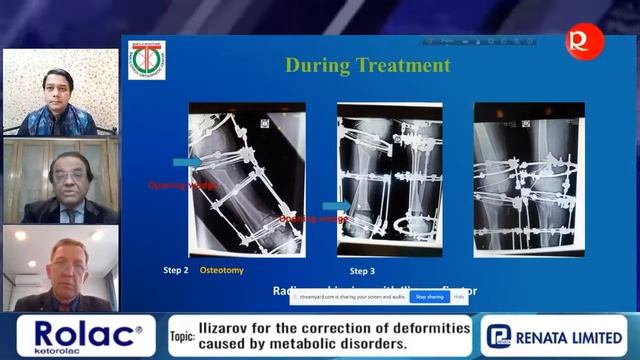 Ilizarov for the correction of deformities caused by metabolic disorders 2 смотреть онлайн