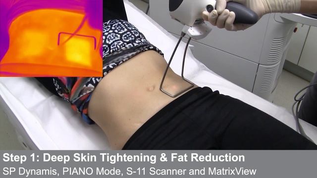 TightSculpting laser Fotona смотреть онлайн
