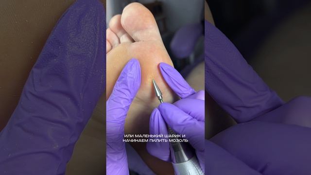 Как удалить стержневую мозоль на стопе смотреть онлайн