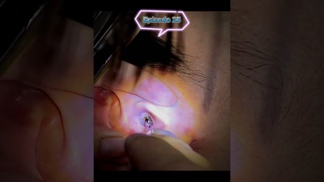 Earwax Removal. Dry And Hard Earwax As Rock.
