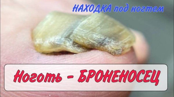 Волосы под ногтем _ толстый ноготь _ ретронихия _ онихогрифоз