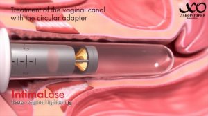 ЛАЗЕРНОЕ ЛЕЧЕНИЕ В ГИНЕКОЛОГИИ