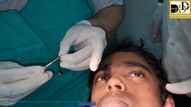 POWER SCOPE 2 - INSTALLATION