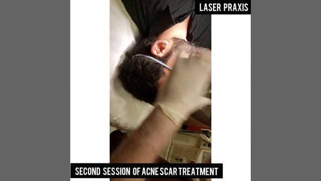 ACNE SCAR TREATMENT WITH FOTONA 4D In Lahore & Mississauga- LASER PRAXIS смотреть онлайн