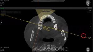 Просмотр зуба на КТ, как найти mb2