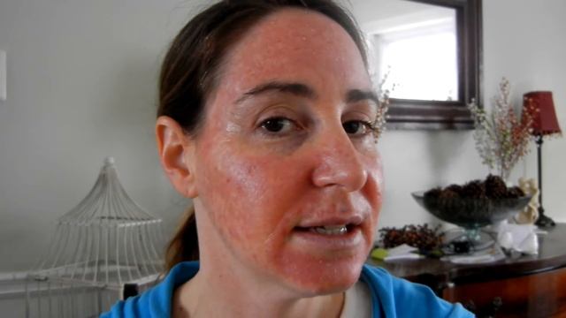 Carac Treatment Day 21! смотреть онлайн
