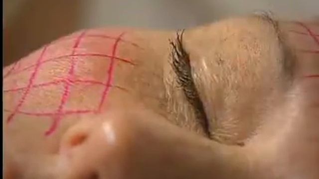 Candela GentleYag Provides Great Skin Tightening Results смотреть онлайн