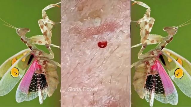 Relax squeezing out blackheads #64 Черные точки смотреть онлайн