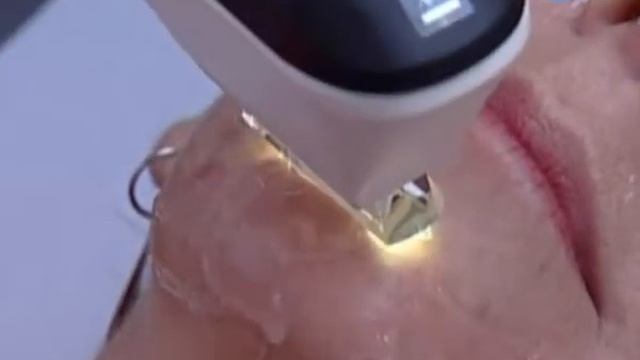 Ellipse IPL / Acné смотреть онлайн