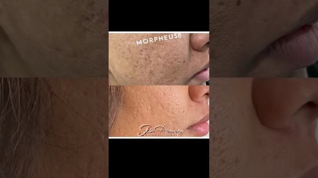 Morpheus8 | Skin Heaven Aesthetics & Wellness #medspa #skinheavenmedspa #morpheus8 #oc #acnescars смотреть онлайн