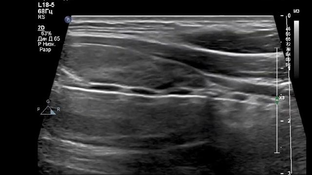 УЗИ щитовидной железы. ТИРЕОИДИТ. Классическая картинка.