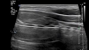 УЗИ щитовидной железы. ТИРЕОИДИТ. Классическая картинка.