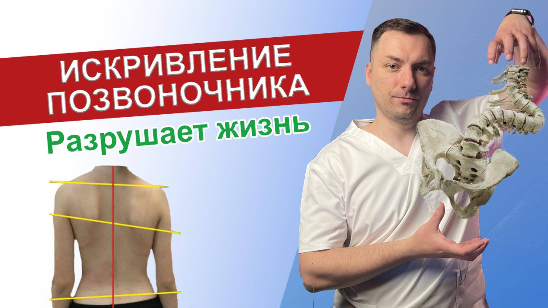 Что такое сколиоз? / Как исправить сколиоз / Искривление позвоночника / смотреть онлайн