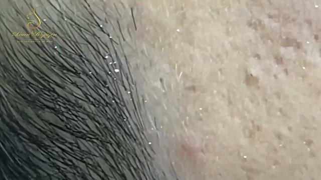 Loan Nguyen Acne Treatment 15422 смотреть онлайн