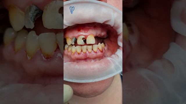 Утро начинается с удаления 11 зубов. Имплантация зубов. смотреть онлайн