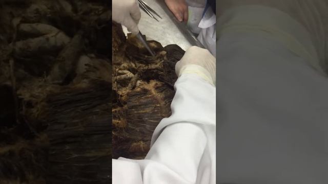 Плечо. Нервы. Анатомия смотреть онлайн