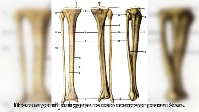 Перелом костей голени у детей смотреть онлайн