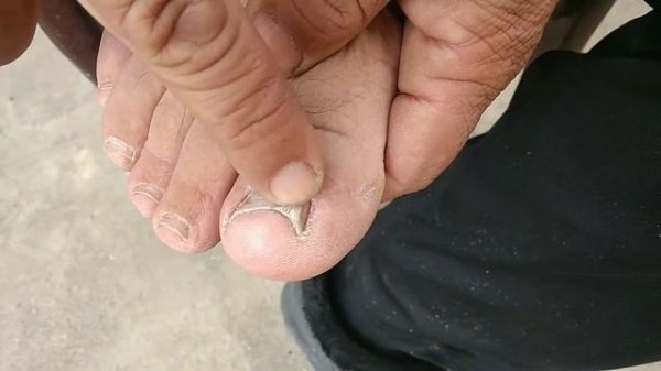 Tirnoq yonga osishi davosi topildi.