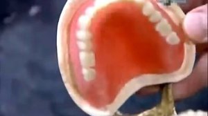 Как делают зубные протезы