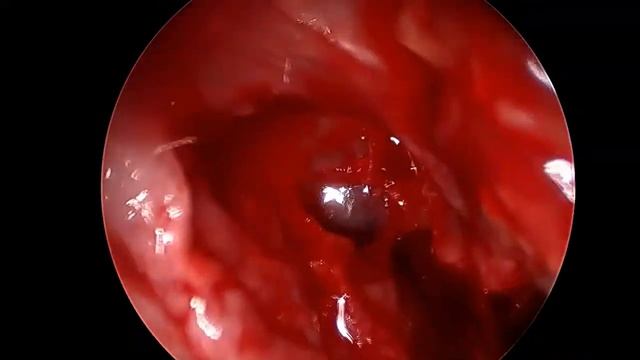 Etmoidectomía anteroposterior смотреть онлайн