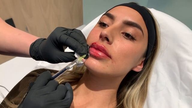 GET THOSE JUICY RUSSIAN LIPS 👄WITH NO DOWNTIME FILLER INJECTIONS | Hollywood, CA | Dr. Jason Emer смотреть онлайн