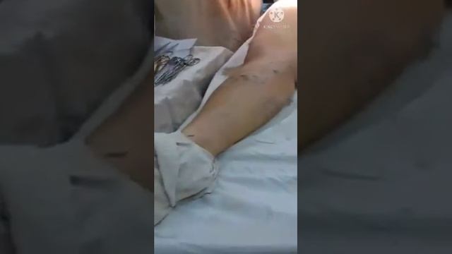 Varikoz Operatsiyasi.   Operatsiyadan Keyin Bemor Yura Olmay Qoldimi