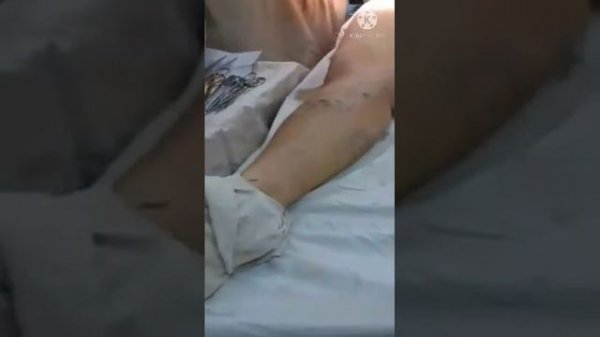 Varikoz operatsiyasi. Operatsiyadan keyin bemor yura olmay qoldimi