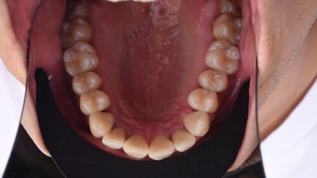 HOW TO USE OCCLUSAL CONTRASTOR for Dental Photography (Black Line) смотреть онлайн