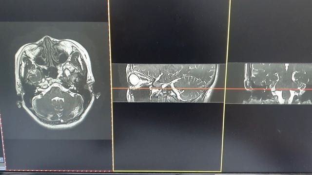 Brain MRI stem Ciss-FIESTA смотреть онлайн