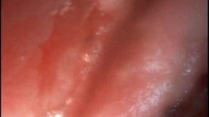 ДИВЕРТИКУЛИТ ТОЛСТОГО КИШЕЧНИКА