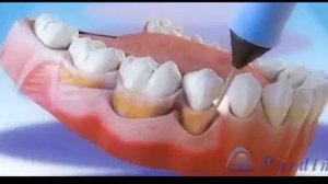 Лечение пародонтоза