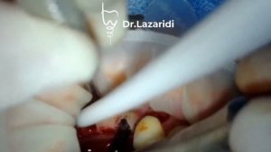 ИМПЛАНТАЦИЯ + НАРАЩИВАНИЕ КОСТНОЙ ТКАНИ \ IMPLANTS PLACEMENT + BONE AUGMENTATION