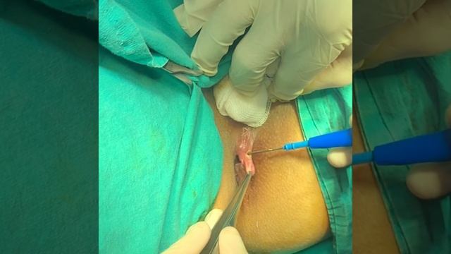 Anal Fissür & Makat Çatlağı & Makatta Yırtık смотреть онлайн