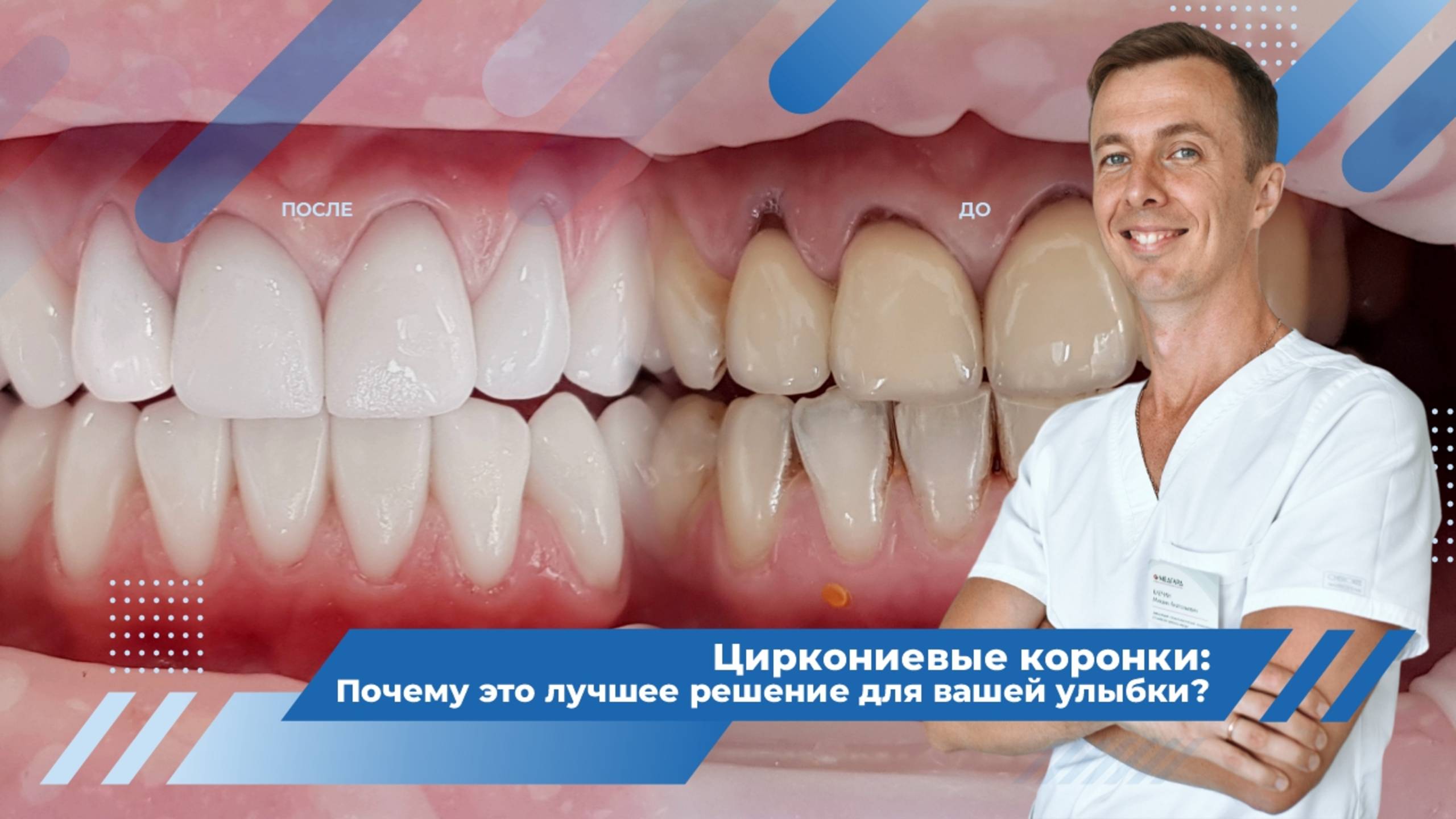 Циркониевые коронки - достоинства и недостатки смотреть онлайн