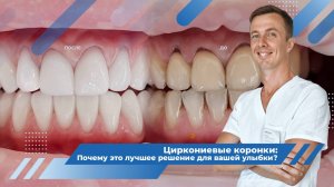 Циркониевые коронки - достоинства и недостатки