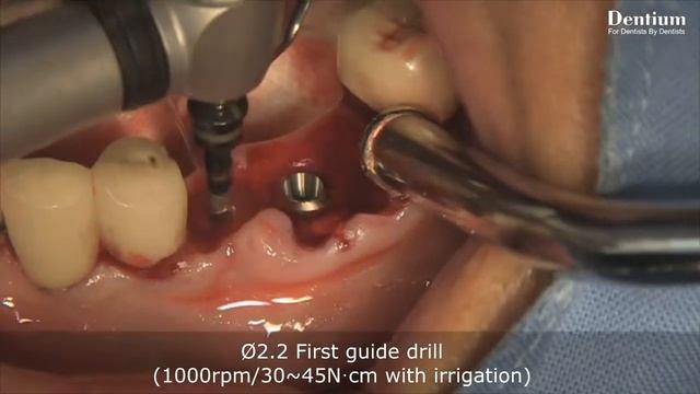 Dentium - Immediate Implantation Using Implant Guide смотреть онлайн
